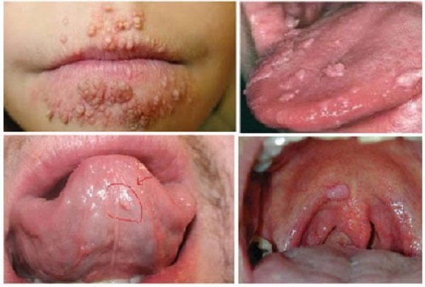 Hình minh họa dấu hiệu sùi mào gà ở miệng, lưỡi, môi